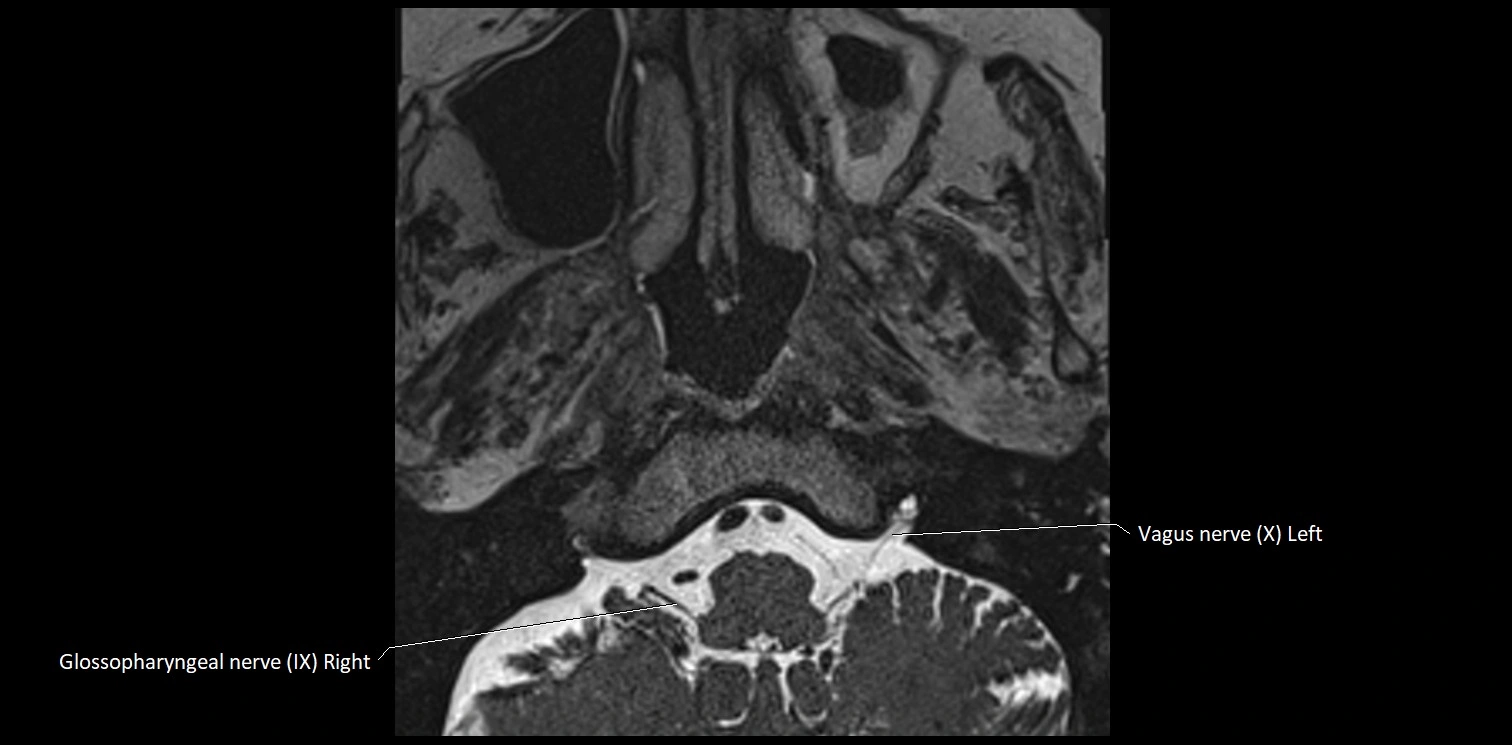 Cranial nerve anatomy axial MRI 3T image 71.webp